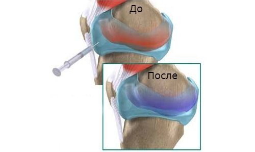 Введение инъекции в сустав Введение инъекции в сустав