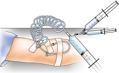 Введение контрастного вещества Введение контрастного вещества