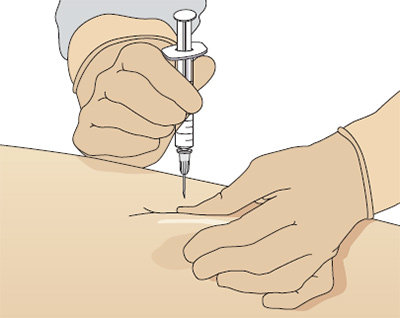 Введение препарата подкожно