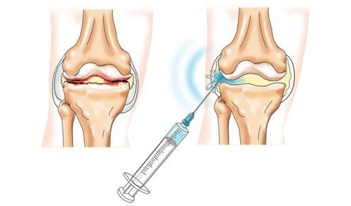 Введение протеза синовиальной жидкости Введение протеза синовиальной жидкости