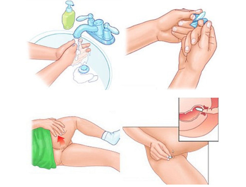 Введение ректальных свечей Введение ректальных свечей
