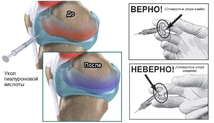 Введение Синокрома Введение Синокрома