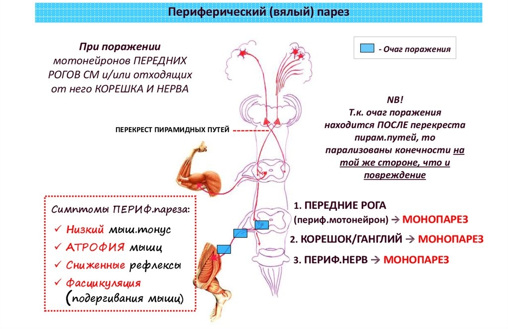 Периферический или вялый парез Периферический или вялый парез