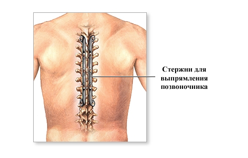 Выпрямление кифоза стержнями Выпрямление кифоза стержнями