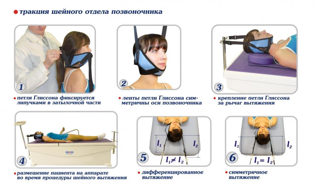 Вытяжение шейного отдела позвоночника Вытяжение шейного отдела позвоночника