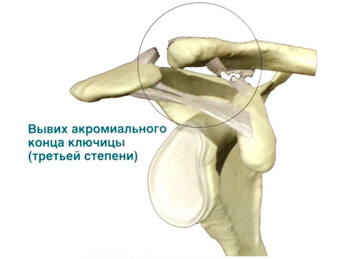 Вывих акромиально-ключичных связок