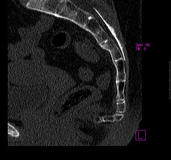 Вывих копчика на КТ снимке Вывих копчика на КТ снимке