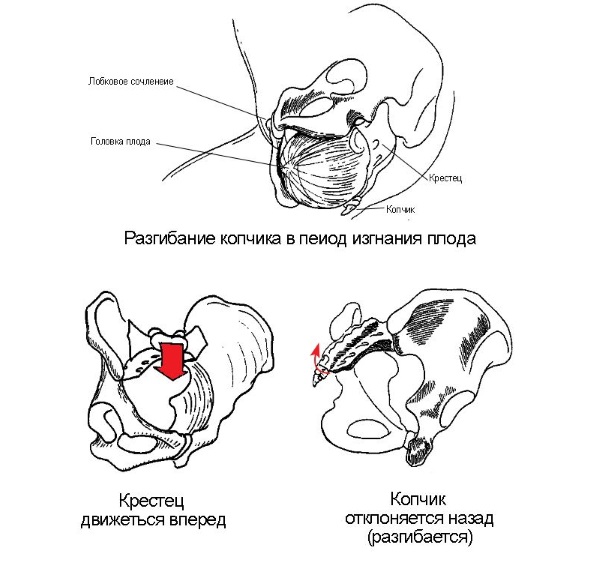 Вывих копчика при родах Вывих копчика при родах