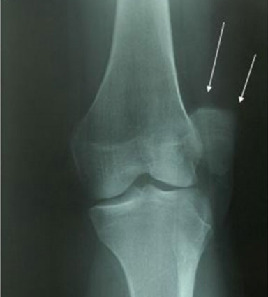 Вывих надколенника на рентген снимке Вывих надколенника на рентген снимке