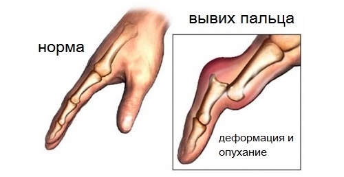 Вывих пальца