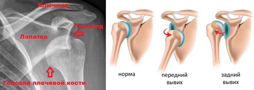 Вывих плеча Вывих плеча