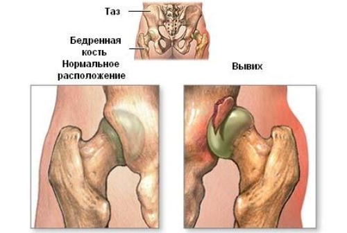 Вывих тазобедренного сустава Вывих тазобедренного сустава