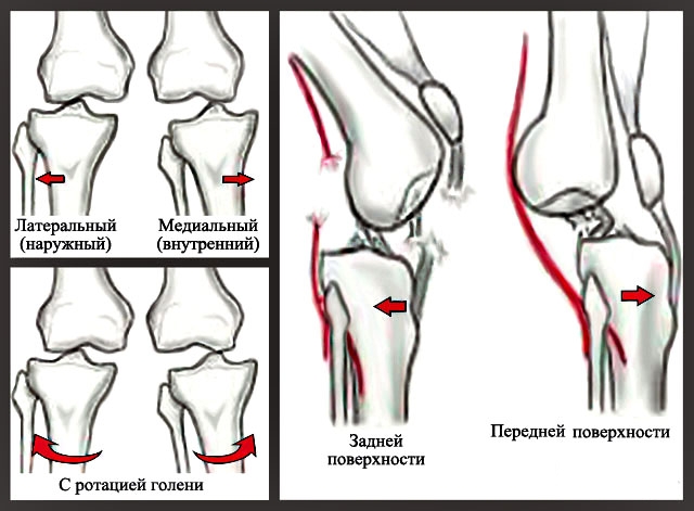 Виды вывихов голени Виды вывихов голени