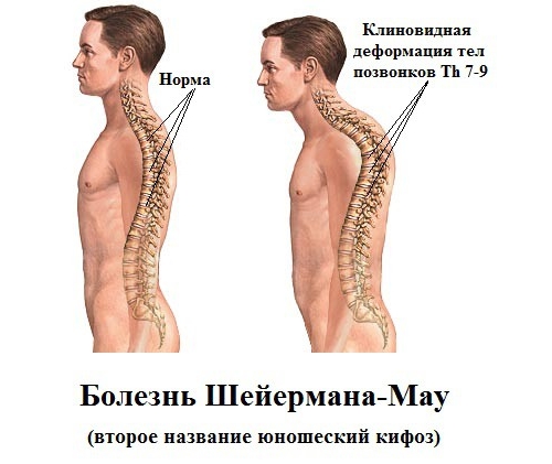 Заболевание Шейермана-Мау Заболевание Шейермана-Мау
