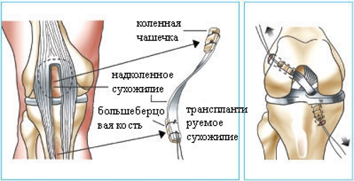 Замена связки коленного сустава Замена связки коленного сустава