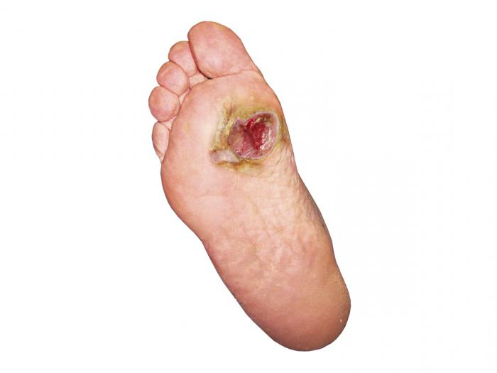 Заражение раны на ступне и развитие некроза Заражение раны на ступне и развитие некроза