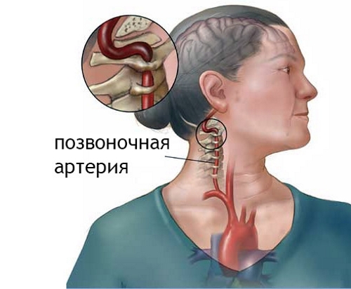 Передавливание позвоночной артерии Передавливание позвоночной артерии