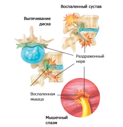 Защемление нерва при грыже позвоночника Защемление нерва при грыже позвоночника