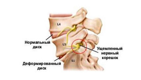 Защемление нерва при остеохондрозе Защемление нерва при остеохондрозе