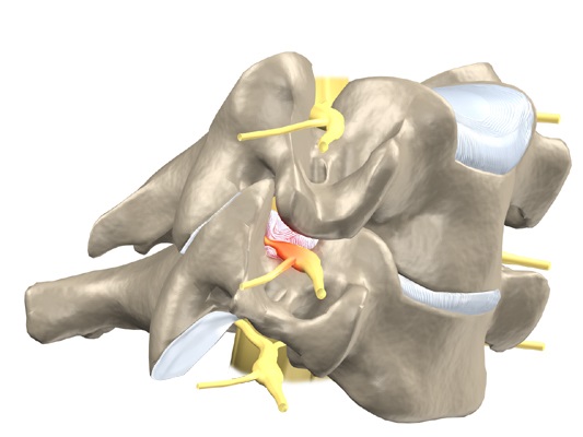 Защемление нерва Защемление нерва